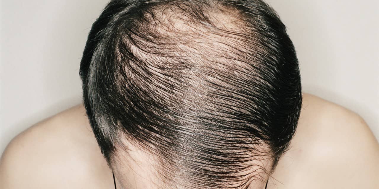 hair loss treatment online