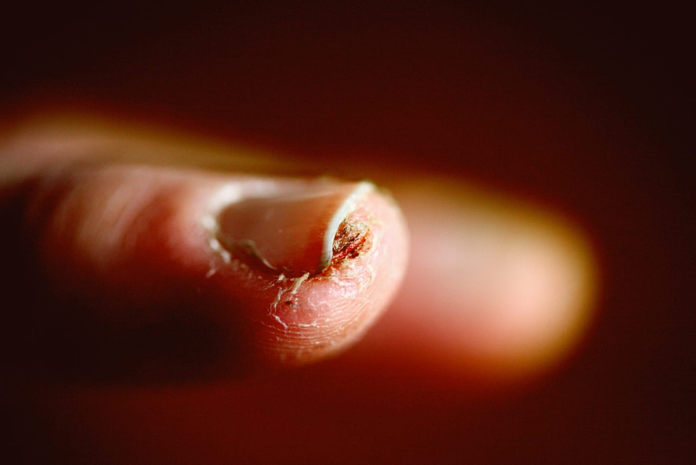 Close-up of a thumb with signs of fungal nail infection showing redness, dryness, and irritation under the nail