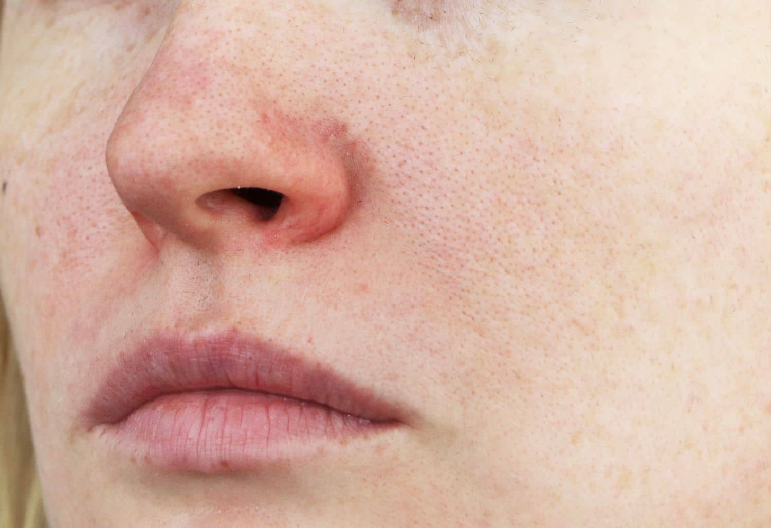 rosacea treatment