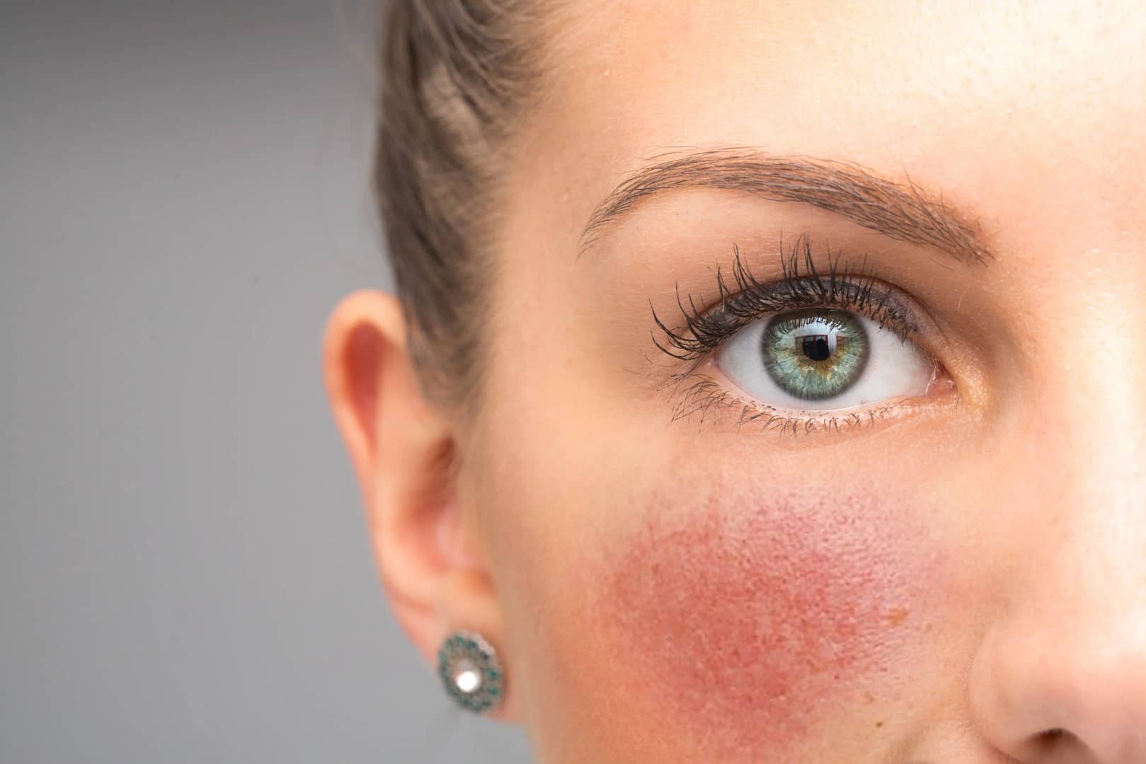 rosacea treatment online