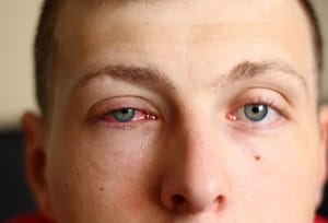 man suffering from pink eye