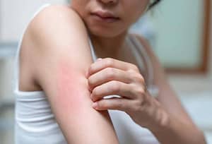 woman with skin rash