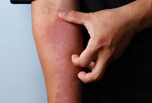 Eczema skin scratching