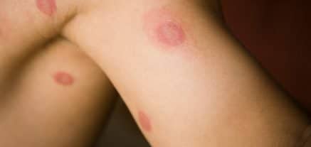 ringworm treatment