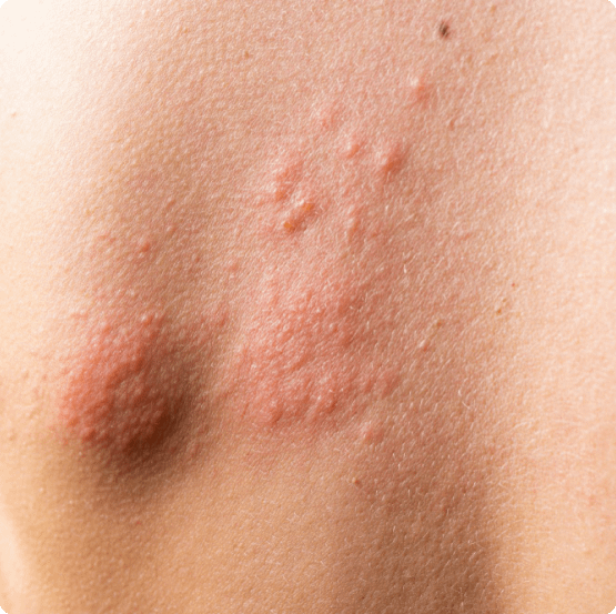 shingles treatment