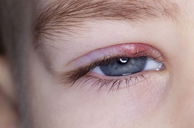 stye treatment online