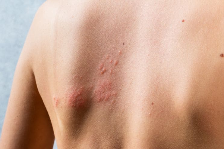 shingles treatment online