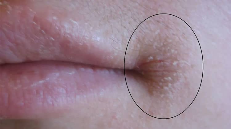 angular-cheilitis