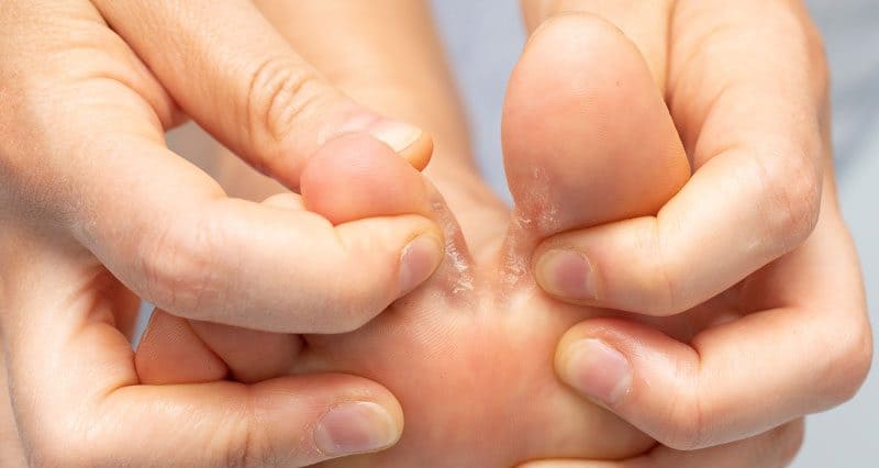 athletes foot disease image