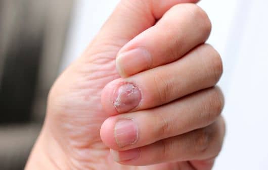 nail infection treatment