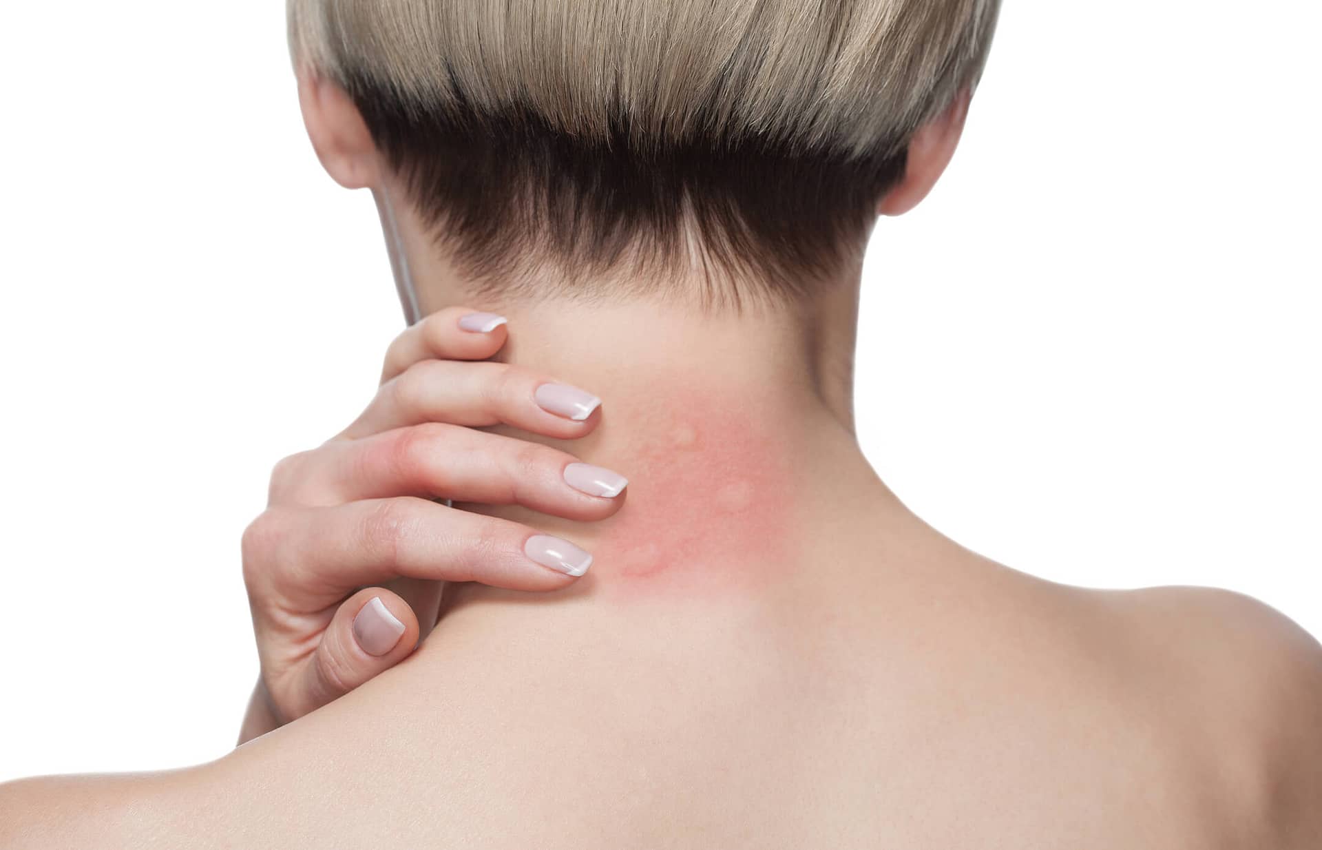 rash treatment online