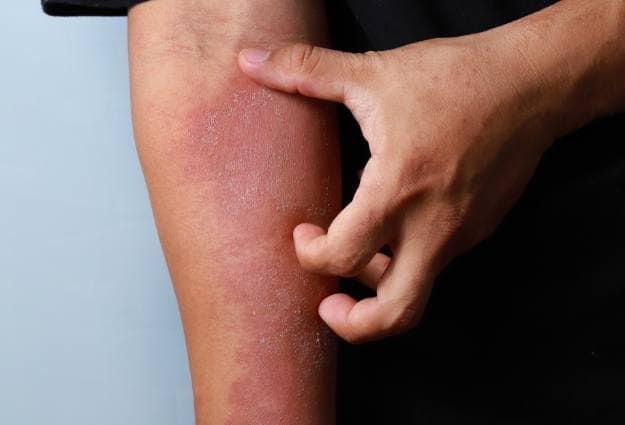 Eczema skin scratching