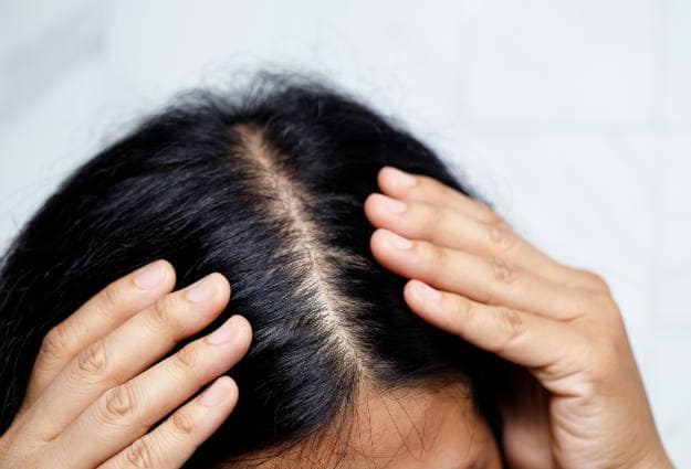 woman with hair loss